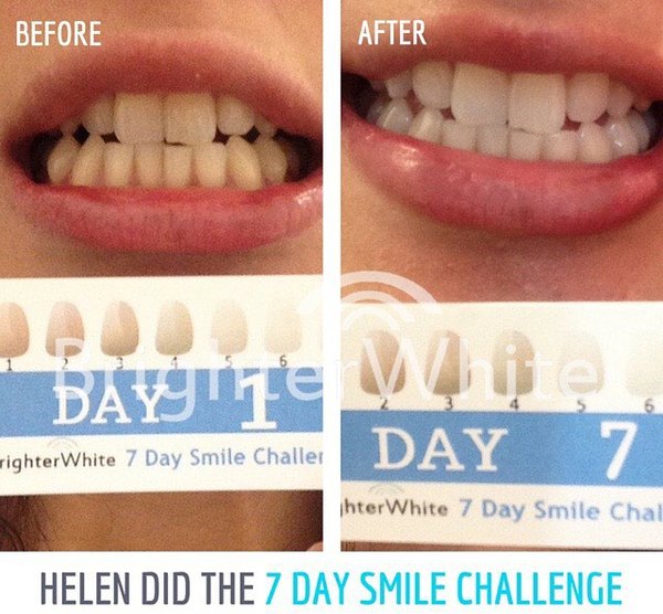 Helen - customer before and after photo