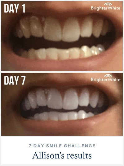 Allison · 7 Day Smile Challenge