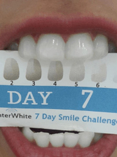 Veronica's teeth on day 7 of the 7 Day Smile Challenge, visibly whiter
