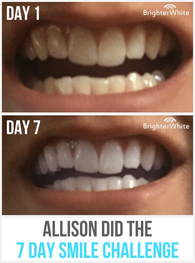 Allison · 7 Day Smile Challenge